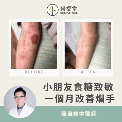 【病案分享：小朋友食糖致敏 一個月改善嚴重濕疹】陳洛志 醫師