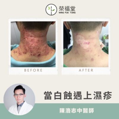 【病案分享：超過10年白蝕遇上濕疹】陳洛志醫師