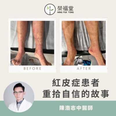 【病案分享：紅皮症患者重拾自信的故事】陳洛志醫師