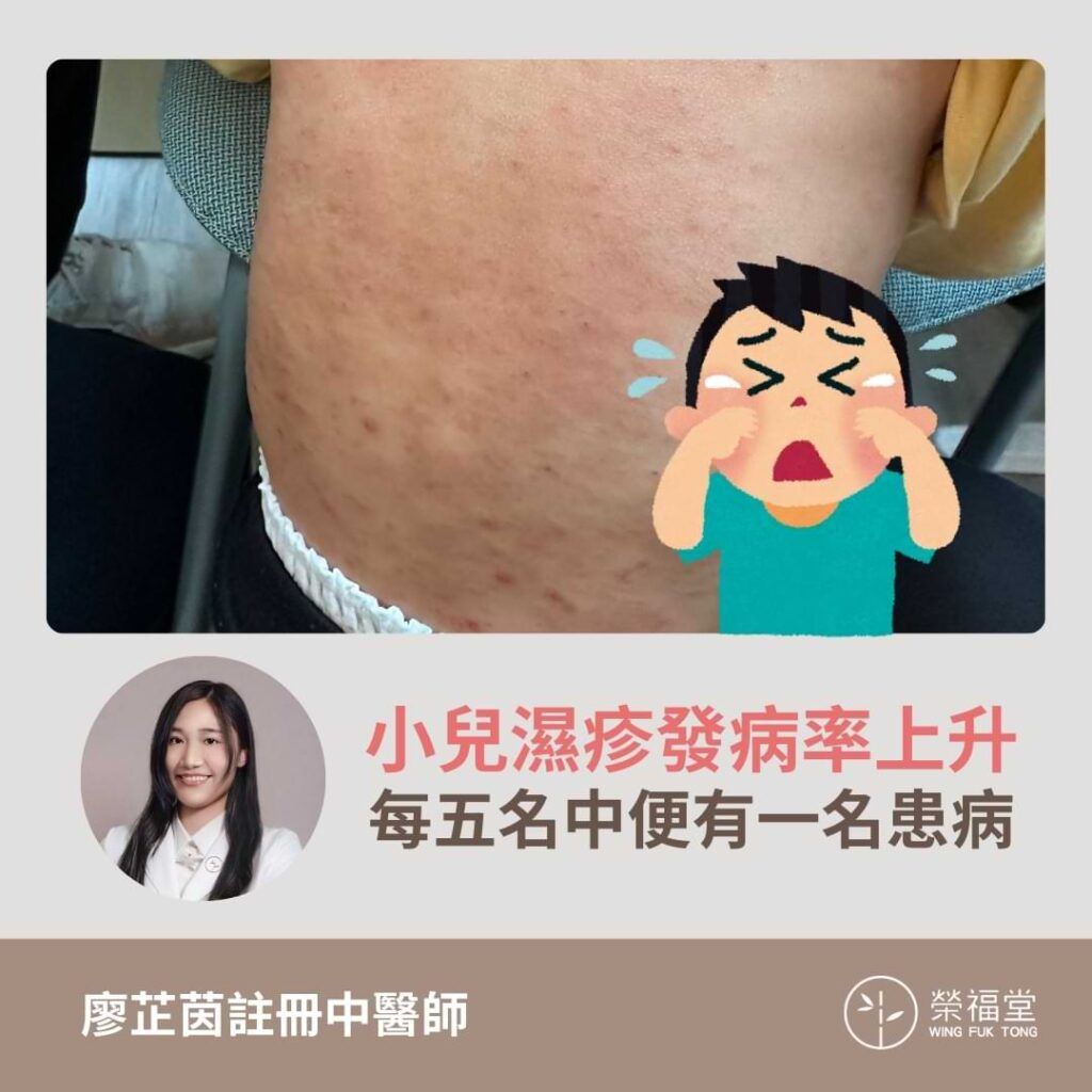 小兒濕疹發病率上升，每五名中便有一名患病