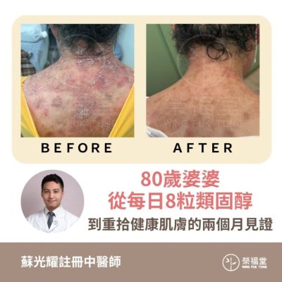 【病案分享：80歲婆婆從每日8粒類固醇，到重拾健康肌膚的兩個月見證  】