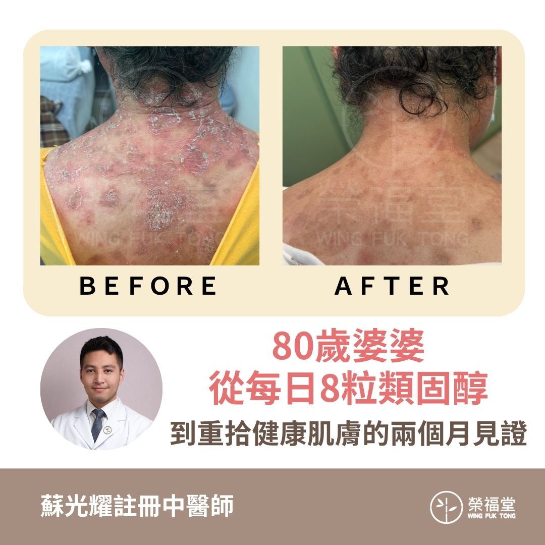 【病案分享：80歲婆婆從每日8粒類固醇，到重拾健康肌膚的兩個月見證  】