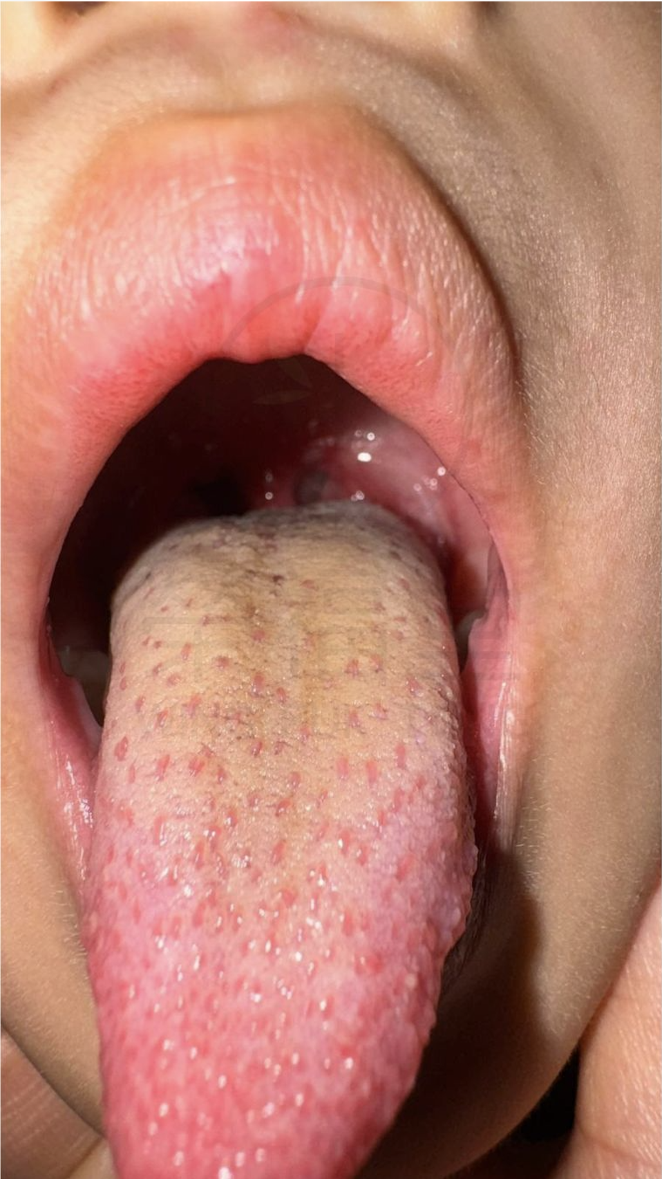 【病案分享 :4歲小孩手足口病 - 中藥vs西藥治療】