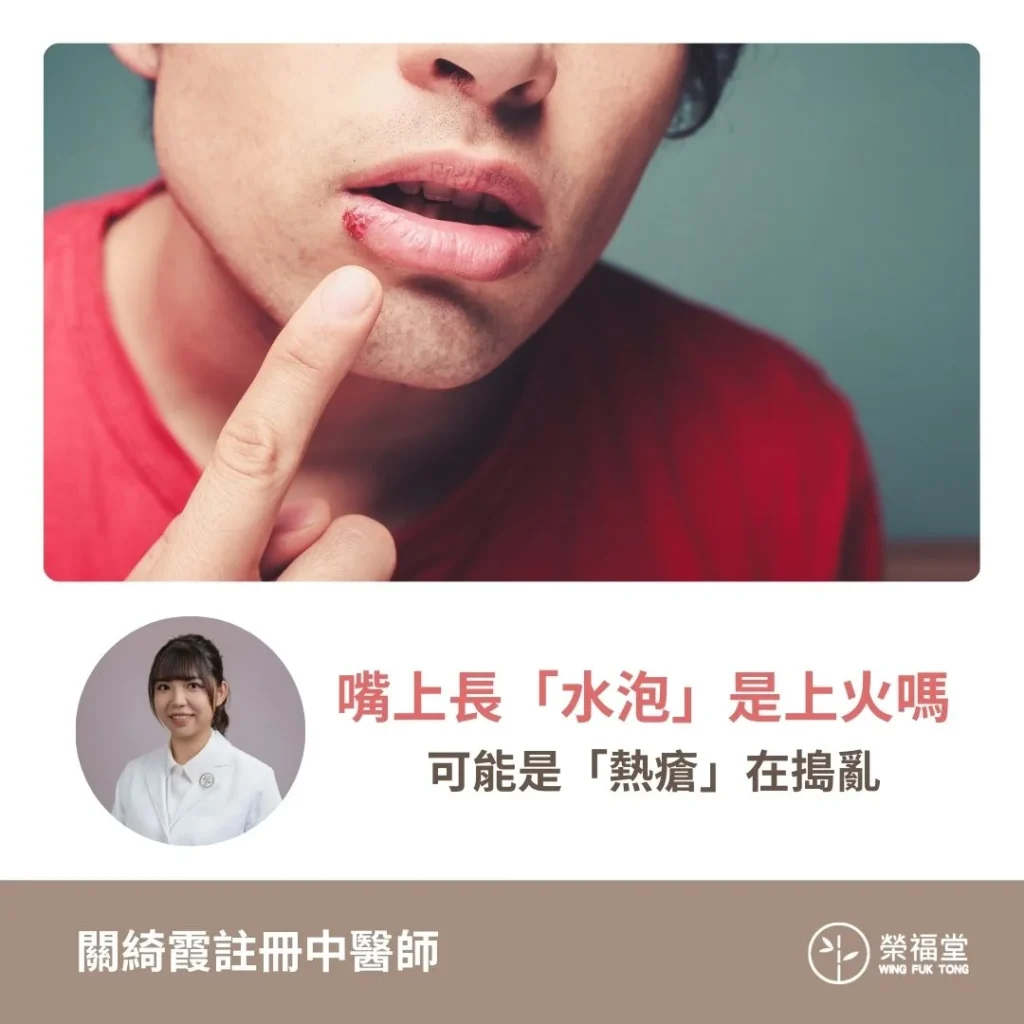 【嘴上長「水泡」，是上火嗎？可能是「熱瘡」在搗亂】關綺霞醫師