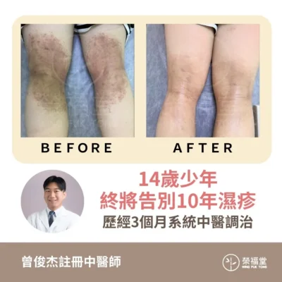 【病案分享:14歲少年終將告別10年濕疹,歷經3個月系統中醫調治】曾俊杰醫師
